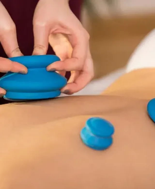 Cupping applied to the upper back during a session at Zone Physical Therapy