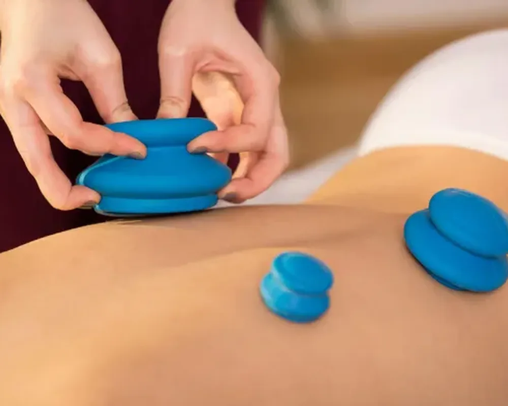 Cupping therapy being applied at Zone Physical Therapy in Greer, SC